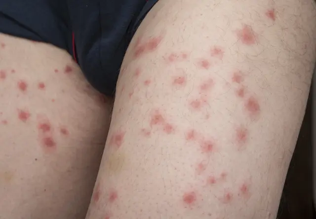 How to Know If You Have Bed Bugs