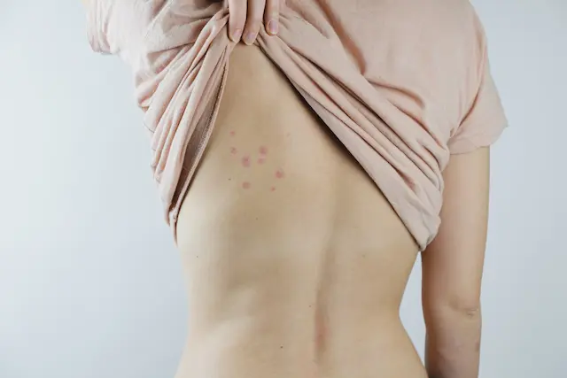 When to Call a Bedbug Exterminator